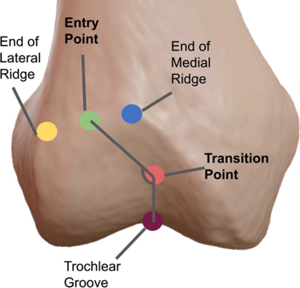 EP-TP Angle EP: midpoint of flattened proximal trochlea TP: point along trochlear groove where direction of the trochlear groove changes from oblique to vertical