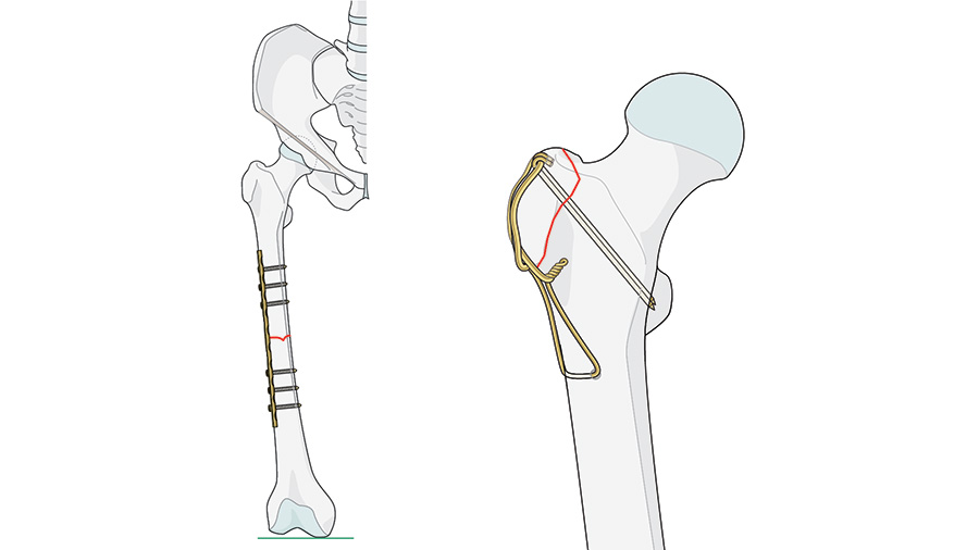 AO Trauma updates educational content on the tension band principle