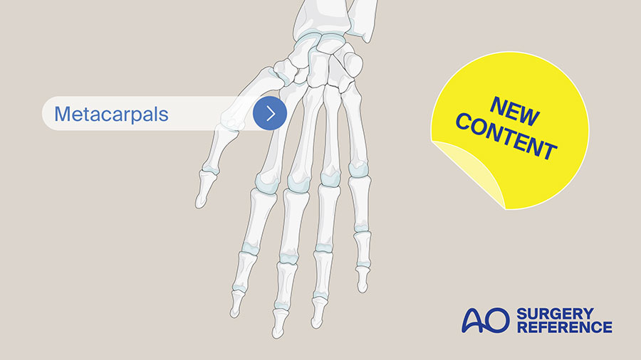 AO Surgery Reference update: Publication of Hand - Metacarpals 