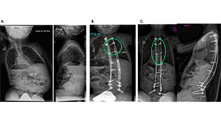 Modern Luque Trolley Technique Promising in Early-Onset Scoliosis