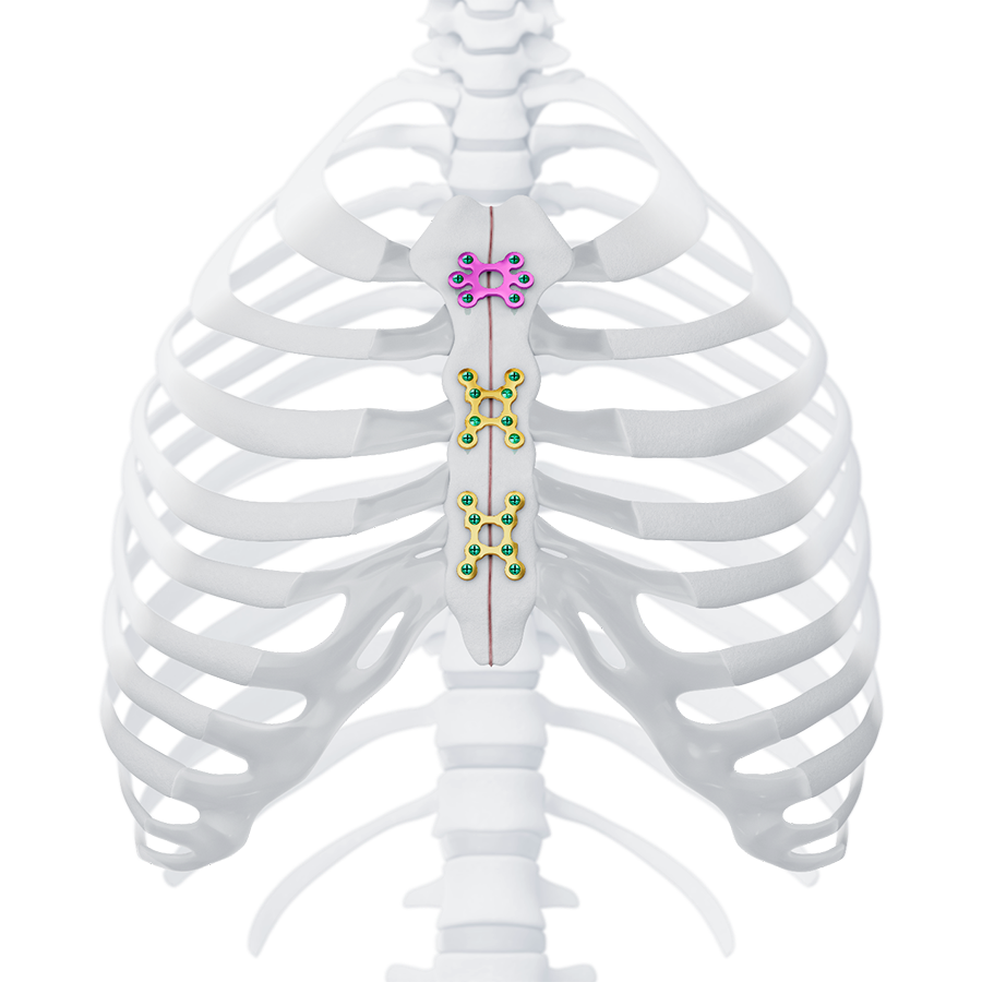 MatrixSTERNUM™ Fixation System 